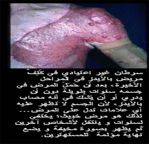 سرطان ايدز